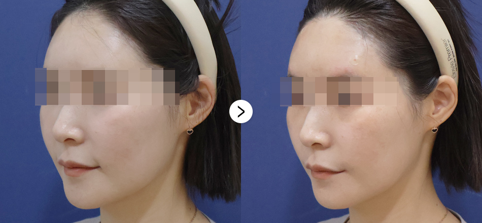 케이톡스 전후사진