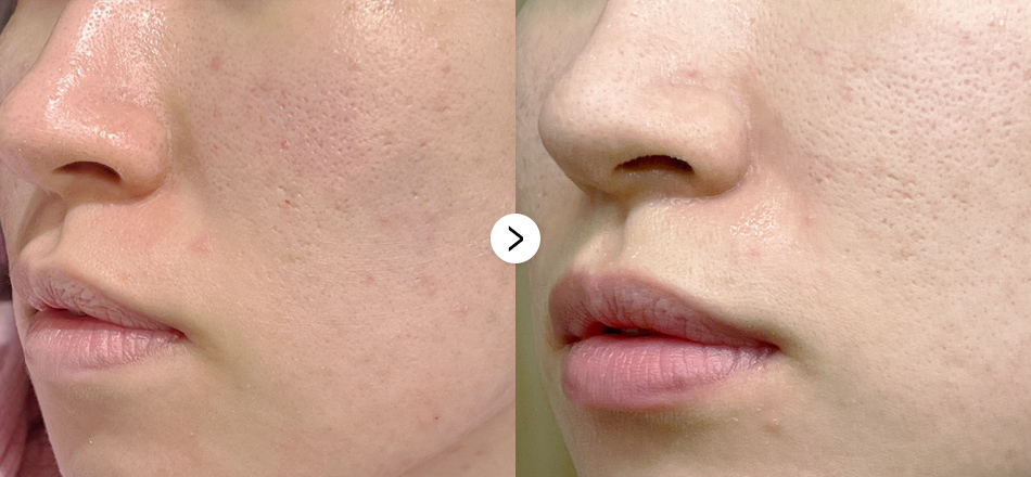 케이톡스 전후사진