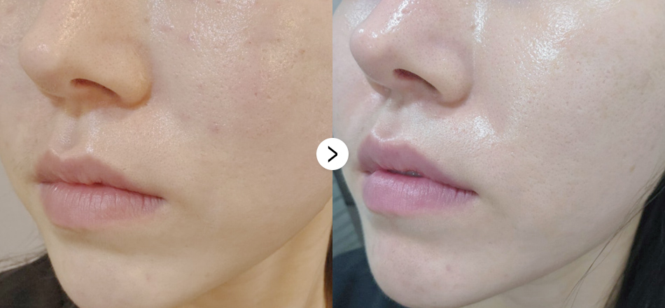 케이톡스 전후사진