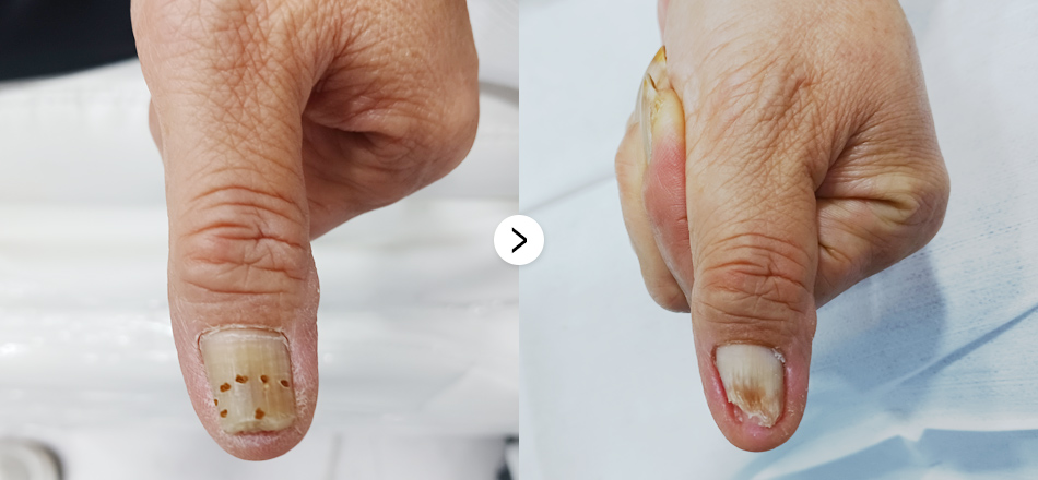 케이톡스 전후사진