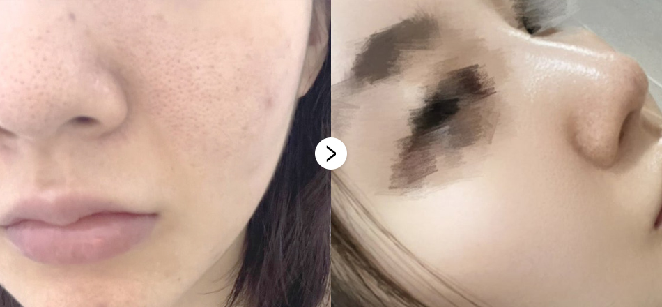 케이톡스 전후사진