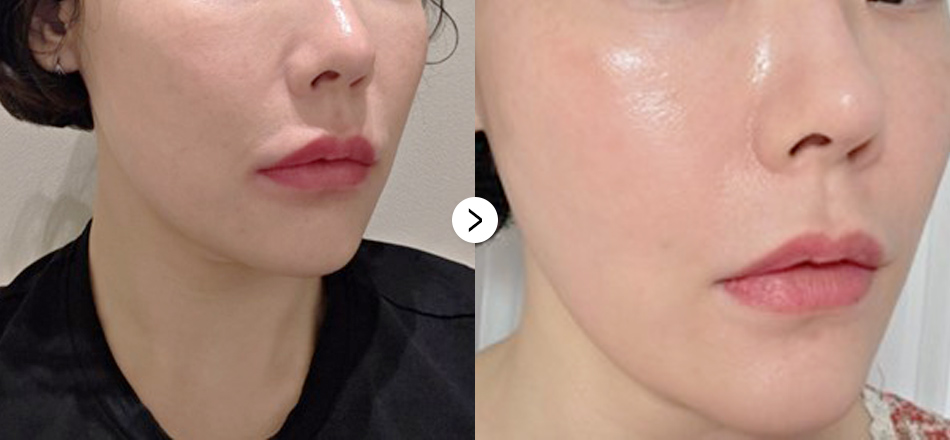 케이톡스 전후사진