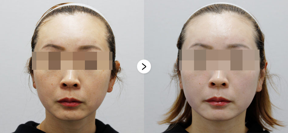 케이톡스 전후사진