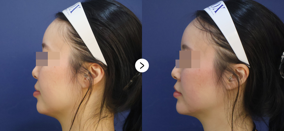 케이톡스 전후사진