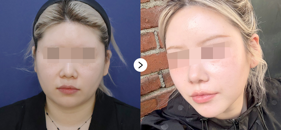 케이톡스 전후사진