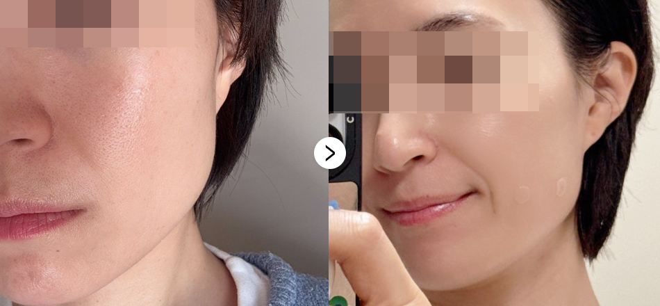 케이톡스 전후사진