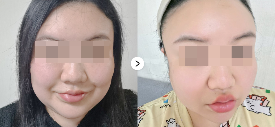 케이톡스 전후사진