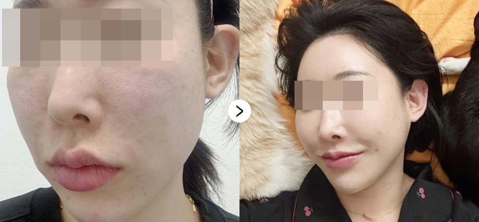 케이톡스 전후사진