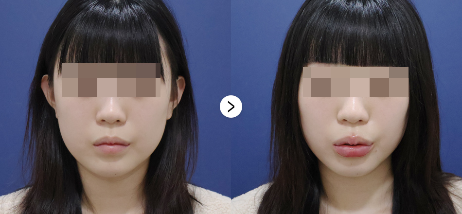 케이톡스 전후사진
