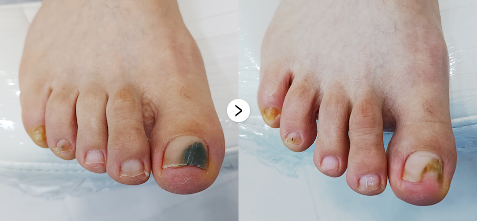 케이톡스 전후사진