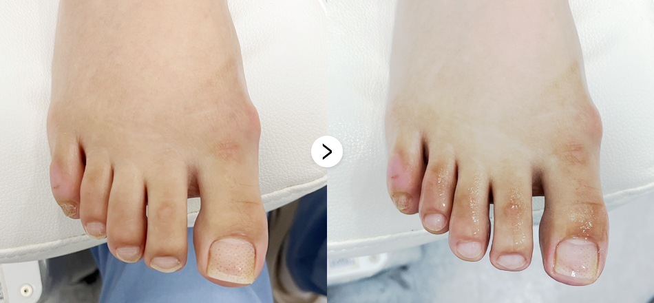 케이톡스 전후사진